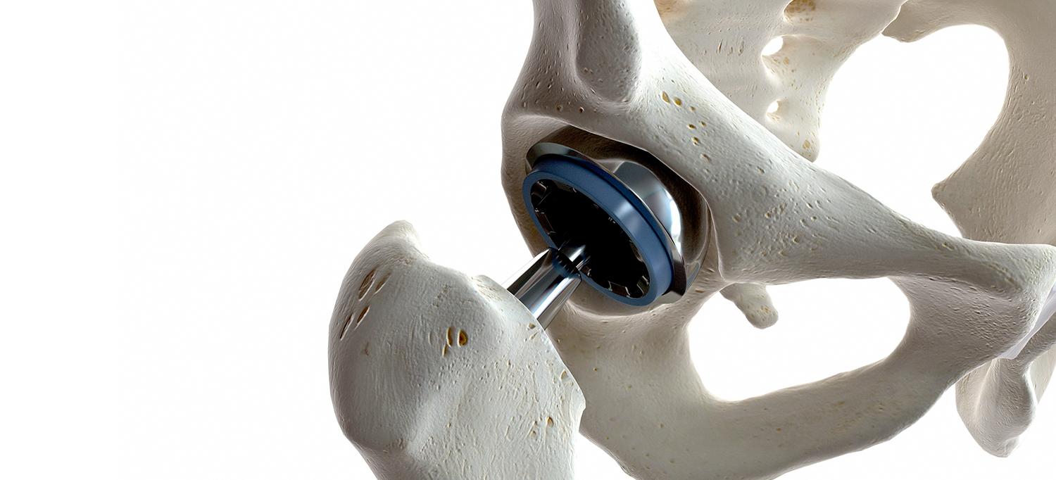 Hip Replacement Model