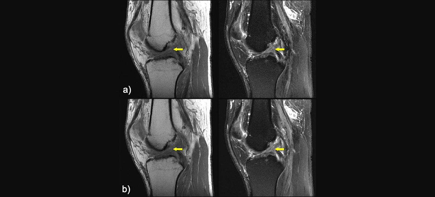 MRI Scans of Knee with Anterior Cruciate Ligament Tear That Show Similarity Between Conventional MRI Scan and Rapid MRI Scans Enhanced by Artificial Intelligence