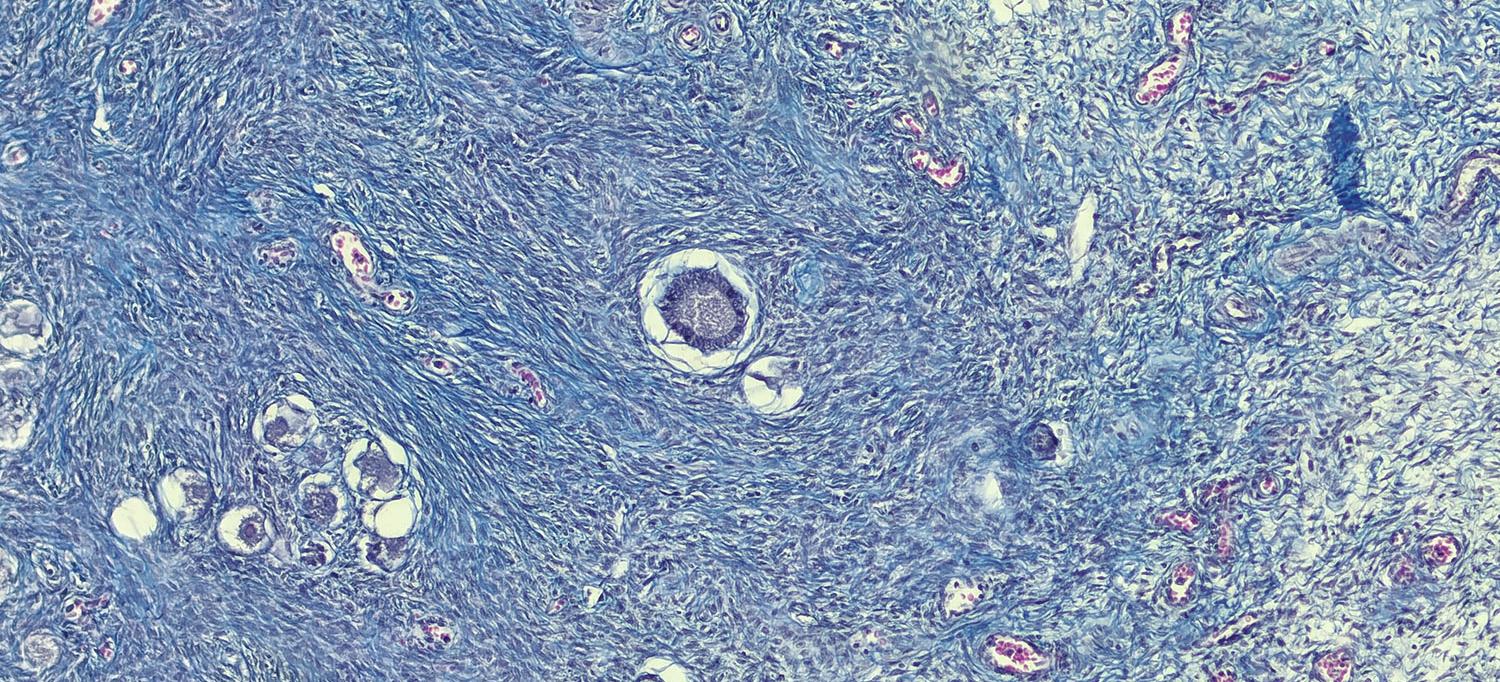 Immunofluorescent Photomicrograph of Uterine Fibroid
