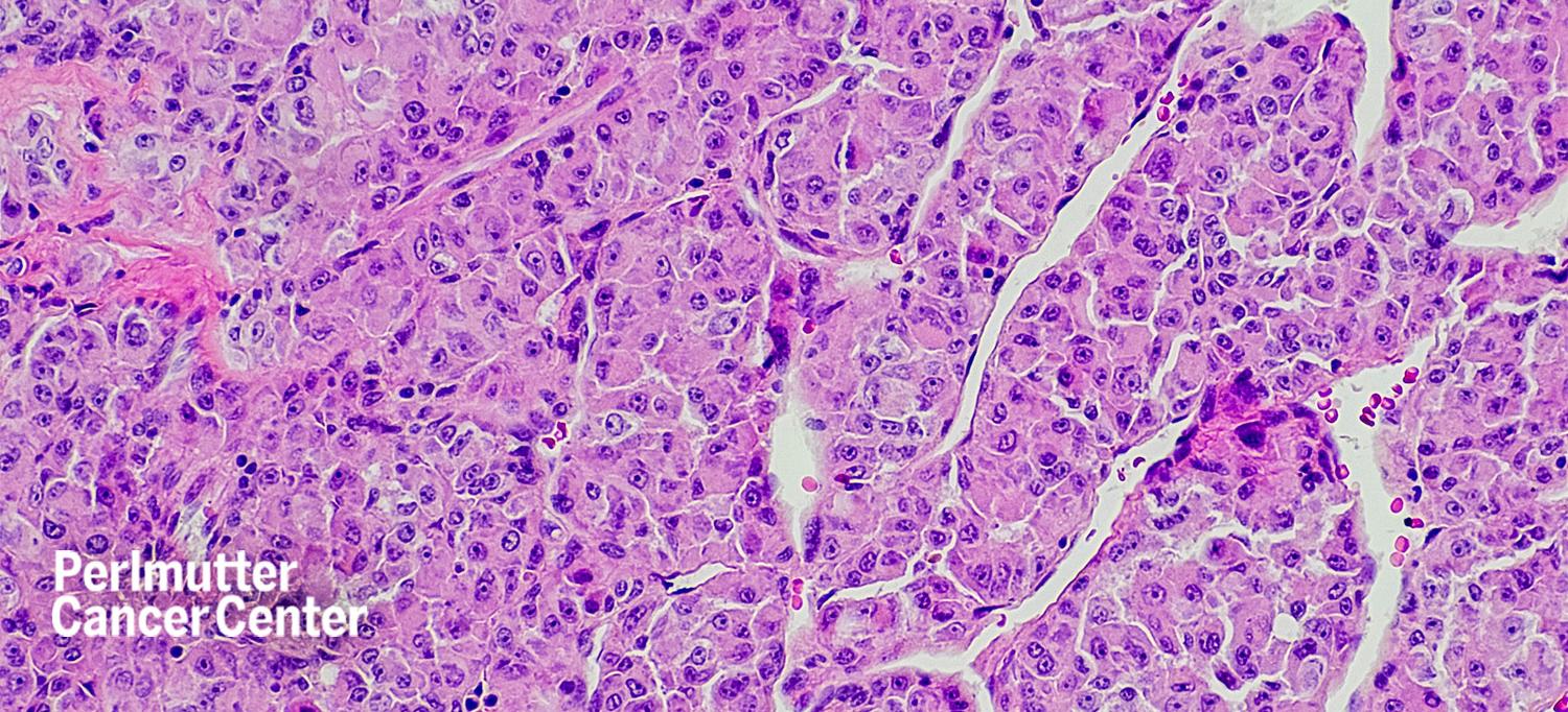Microscopic View of Alveolar Soft Part Sarcoma