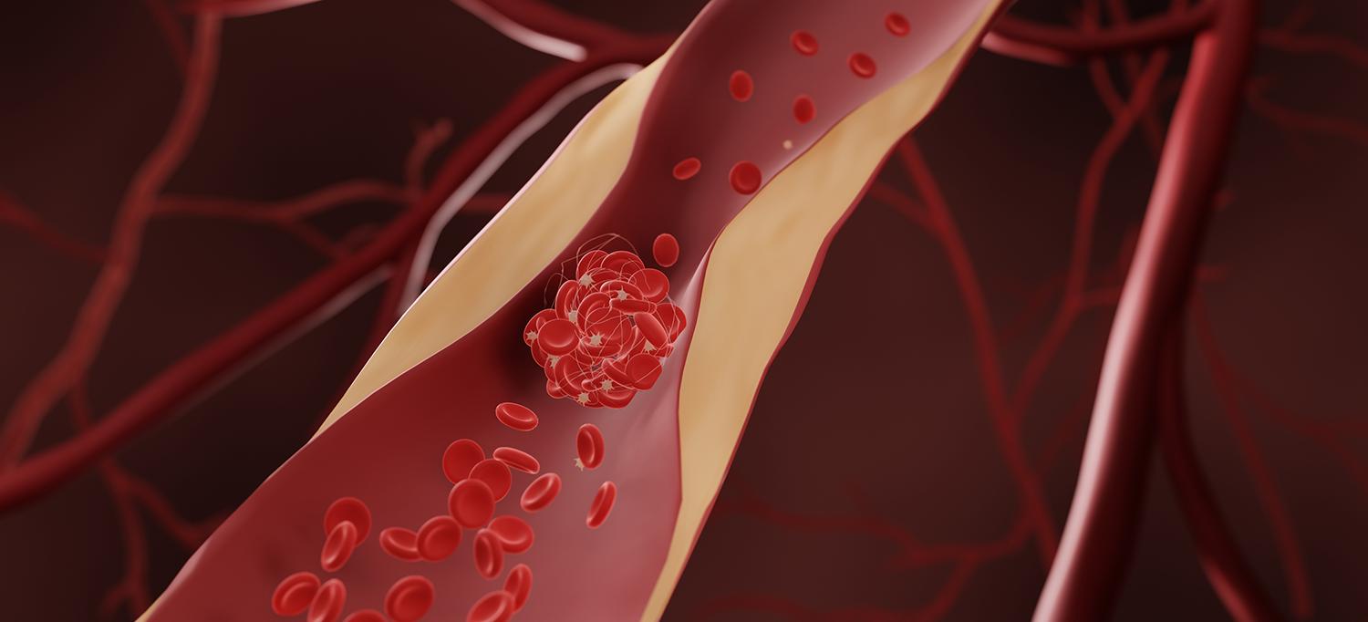 3D Illustration of Blood Clot in Blood Vessel with Artherosclerosis