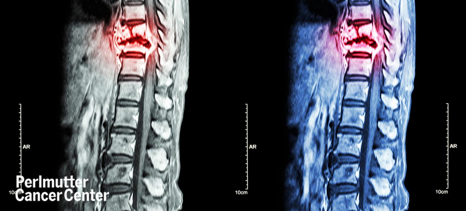 MRI of thoracic and lumbar spine showing thoracic spine metastasis