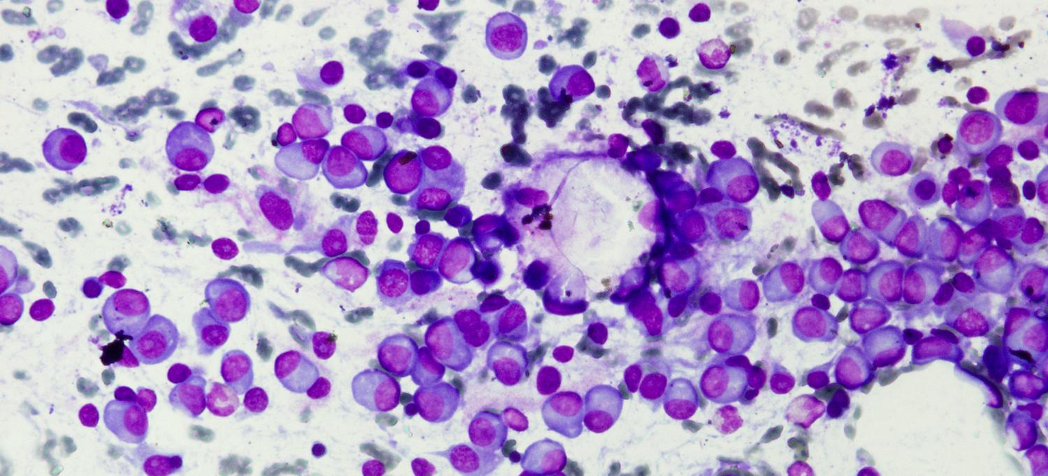 Light micrograph of multiple myeloma