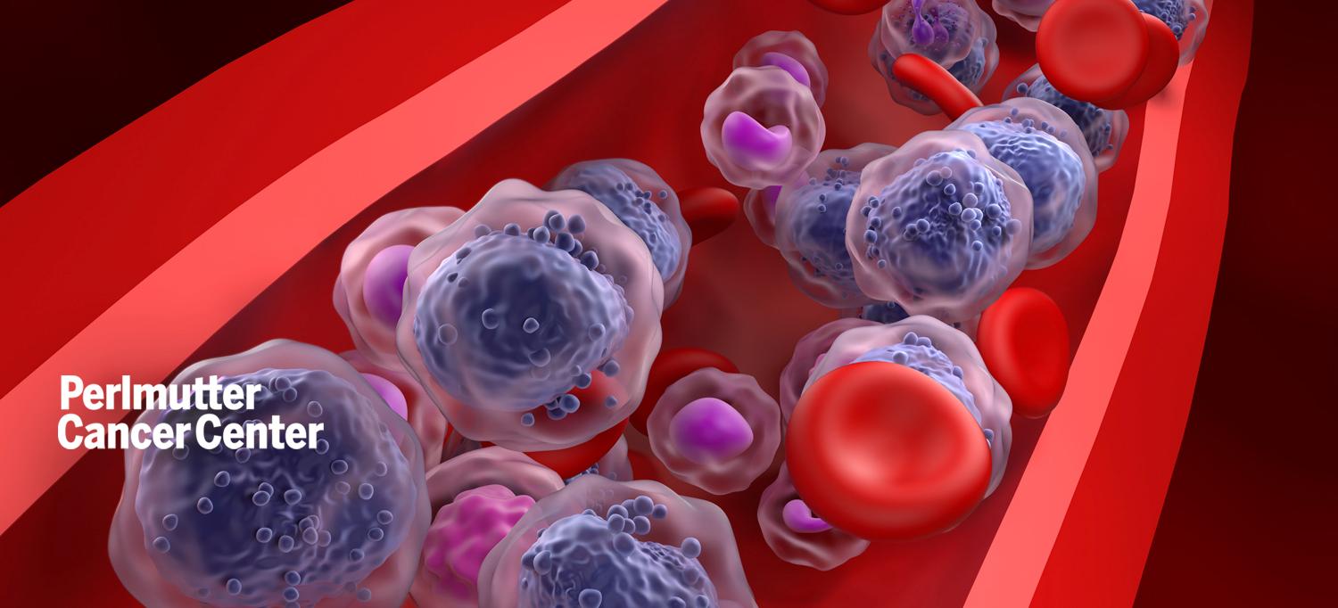 Illustration of acute myeloid leukemia (AML) cells in the bloodstream