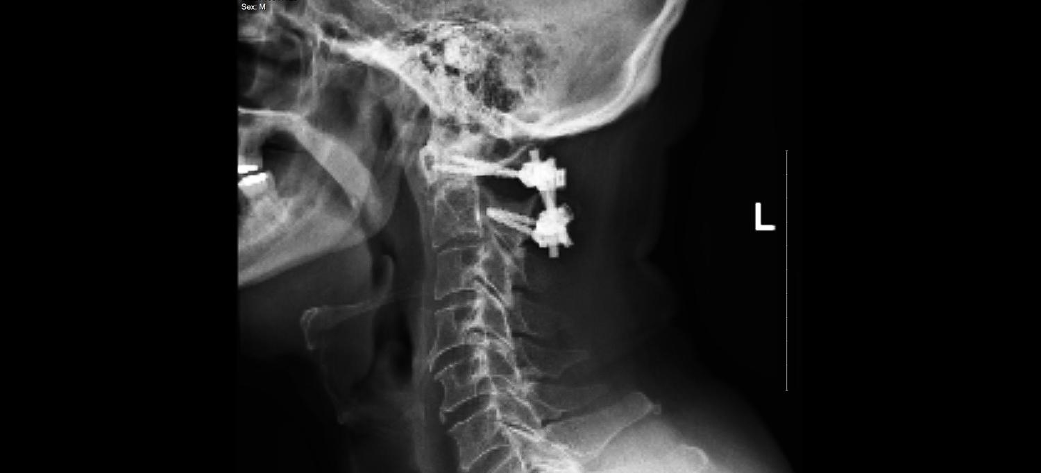 X-ray imaging showing screws and rods in Gibson's spine