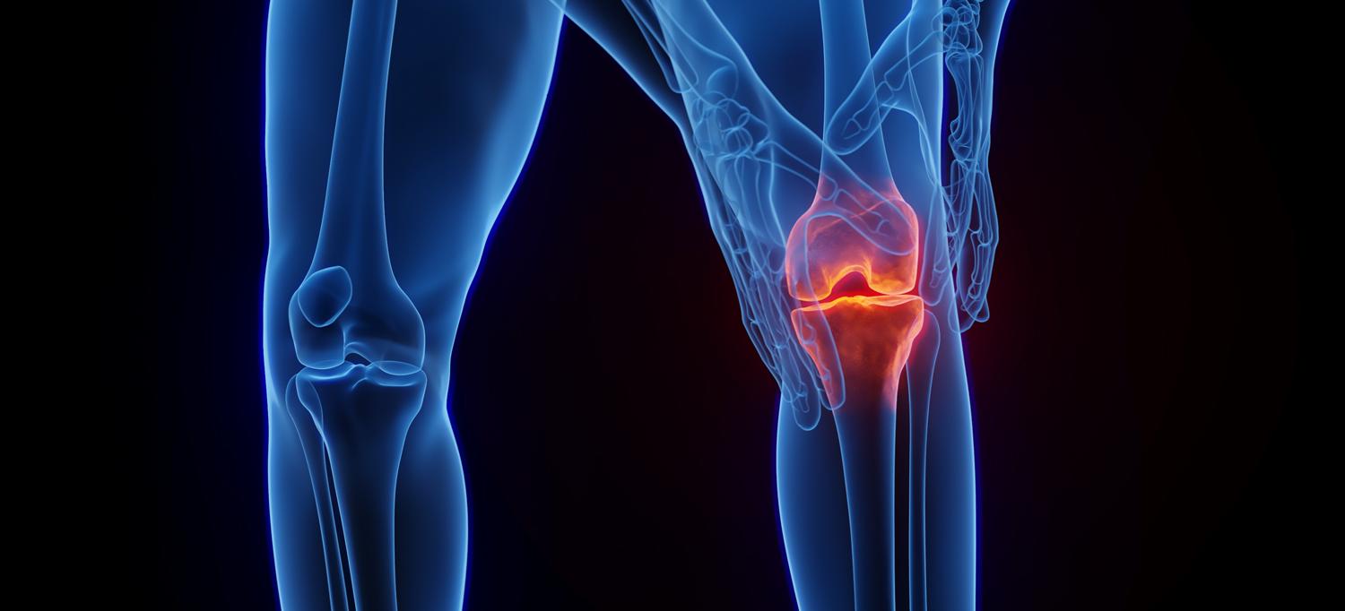 Illustration of a knee showing inflammation