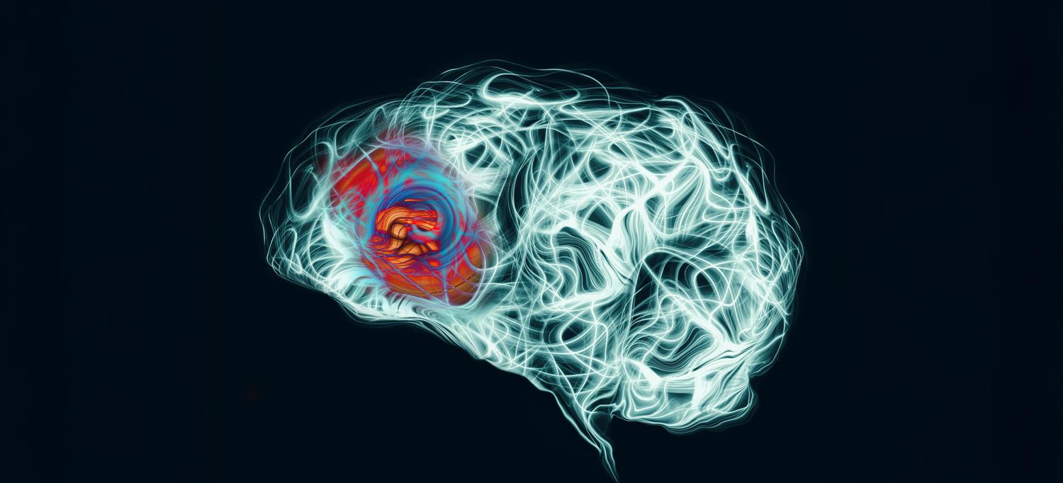 Image of a headache at the front of brain