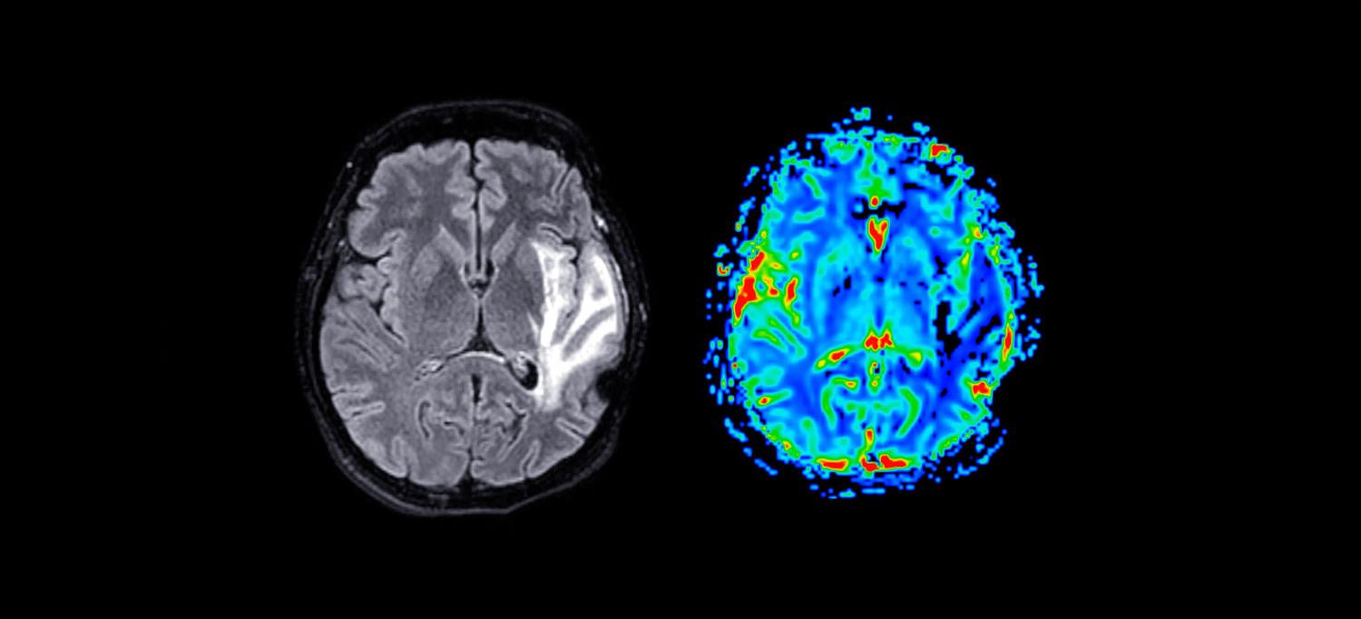 MRI brain perfusion imaging, which is used to assess blood flow and tissue viability