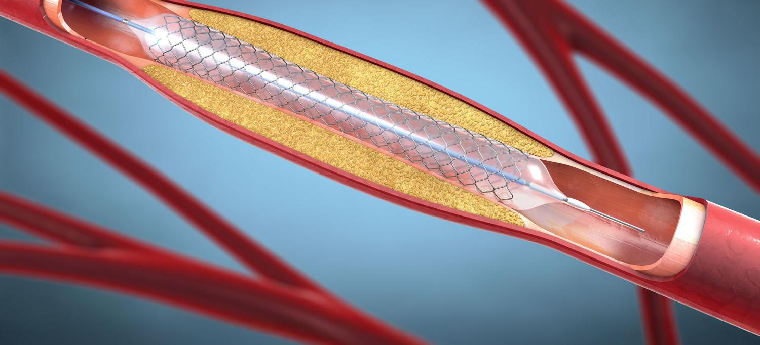 Illustration of a metal stent for implantation into blood vessels