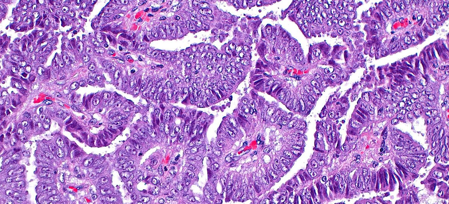 Light micrograph of papillary pattern in lung adenocarcinoma