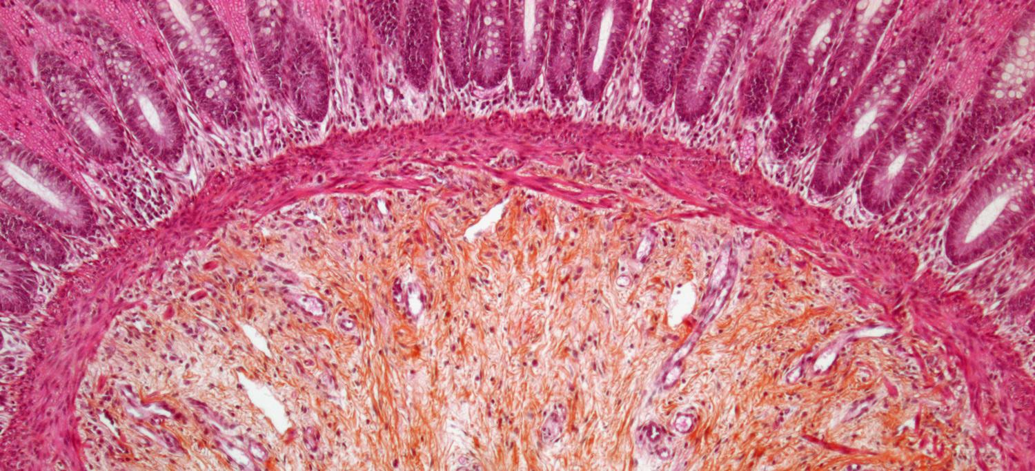 Light micrograph of a section through the enlarged wall of the large intestine (colon) in Hirschsprung's disease