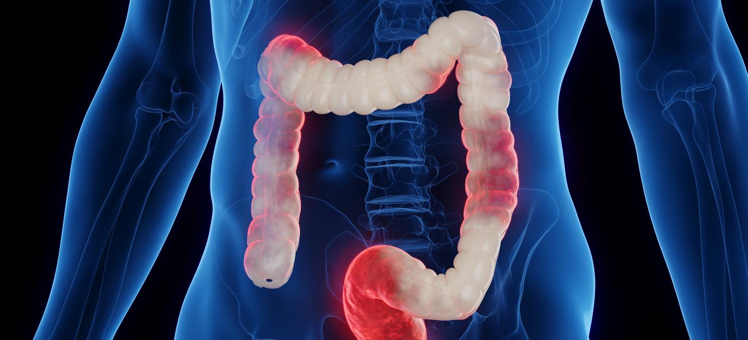 Illustration of an inflamed colon