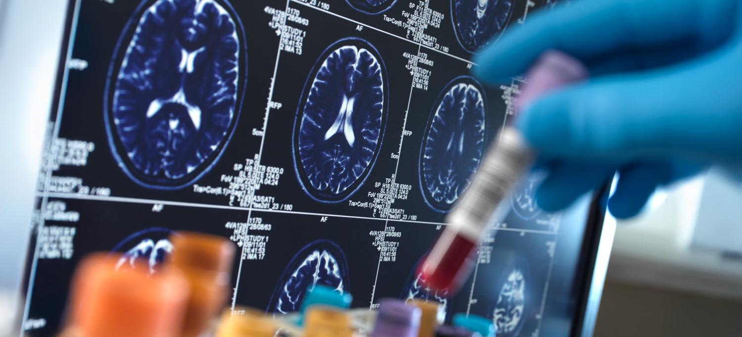  Scientist holding a blood sample during a clinical trial with an MRI on screen