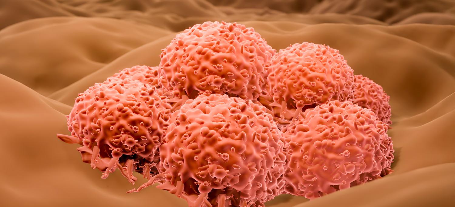 Illustration of skin cancer cells in a tumor