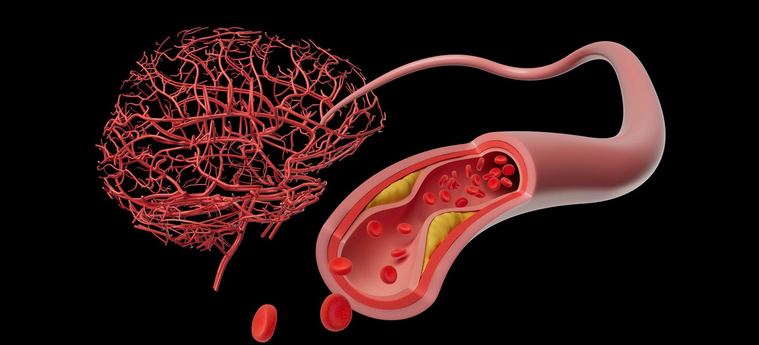 Conceptual illustration of a brain and an artery.  