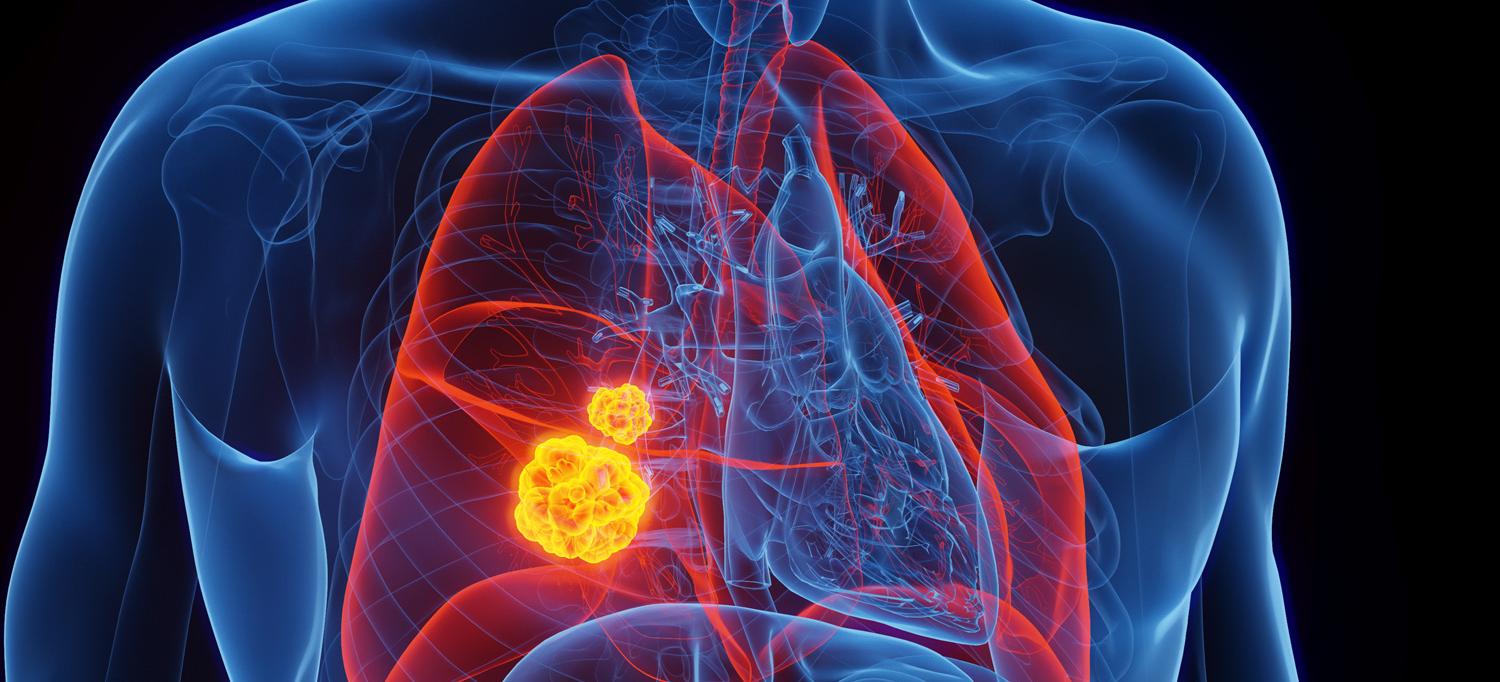 An illustration of lung cancer