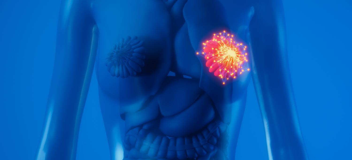 An image of breast cancer cells in a female 