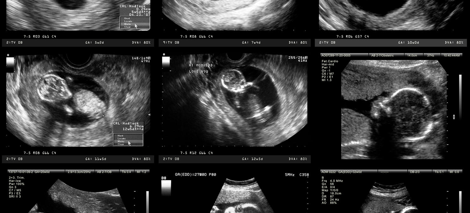 Ultrasound imaging of various stages of embryo and fetal development during pregnancy