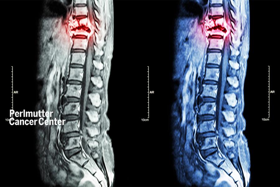 Department Of Radiation Oncology | NYU Langone Health