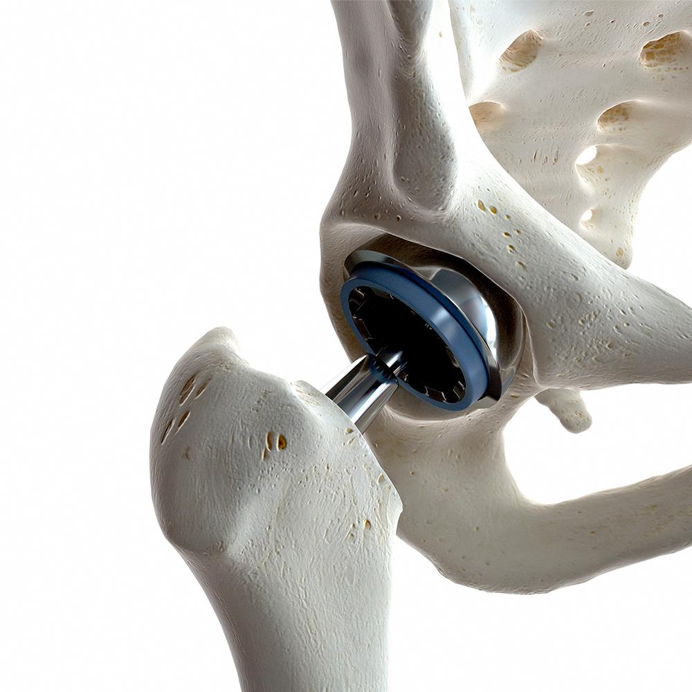 Orthopedics | NYU Langone News