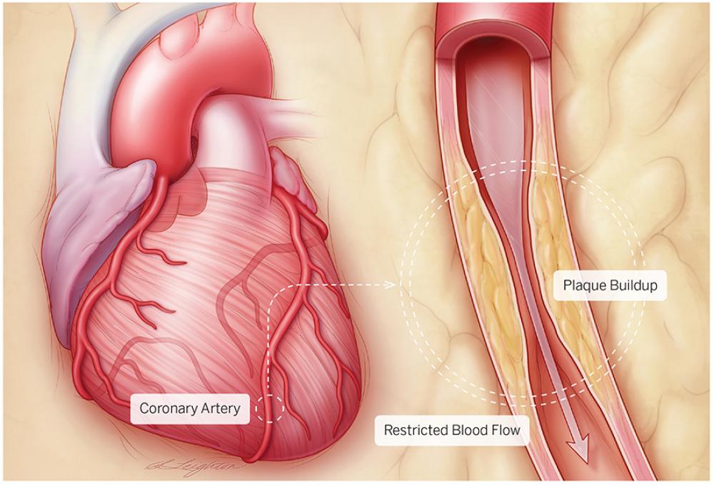 Plaque Buildup in Coronary Artery