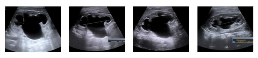 Four Kidney Sonograms from First of Two Patients