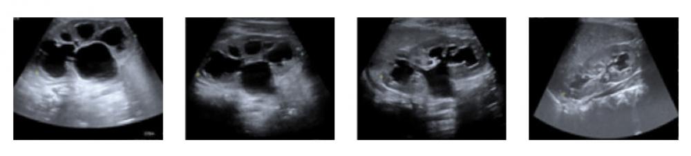 Four Kidney Sonograms from Second of Two Patients