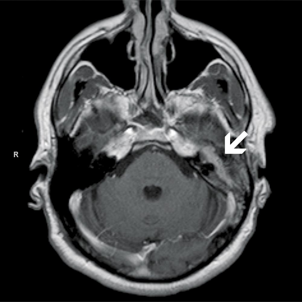 Preoperative Axial MRI Showing the Tumor on the Facial Nerve