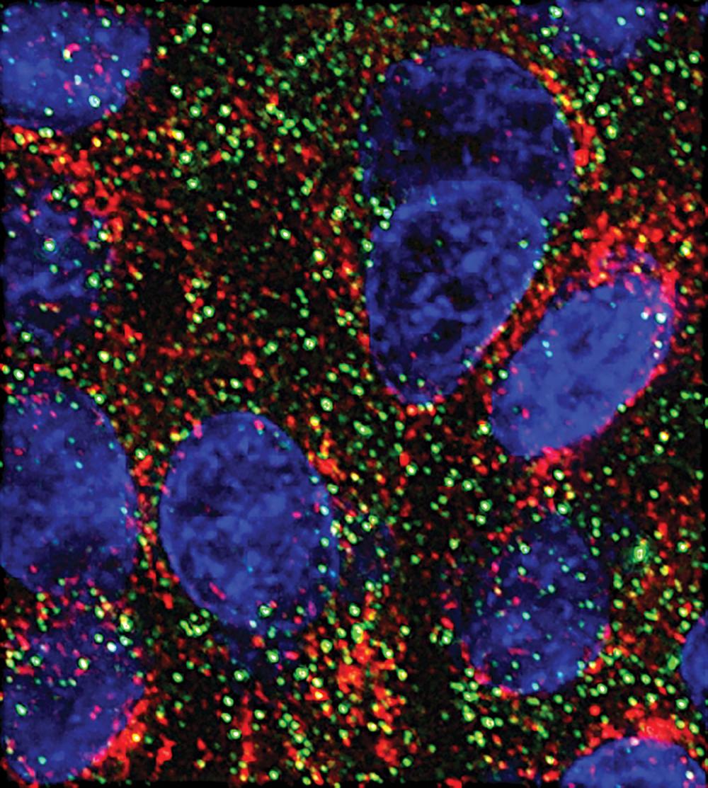 Stress Granules in Pancreatic Cancer Cells
