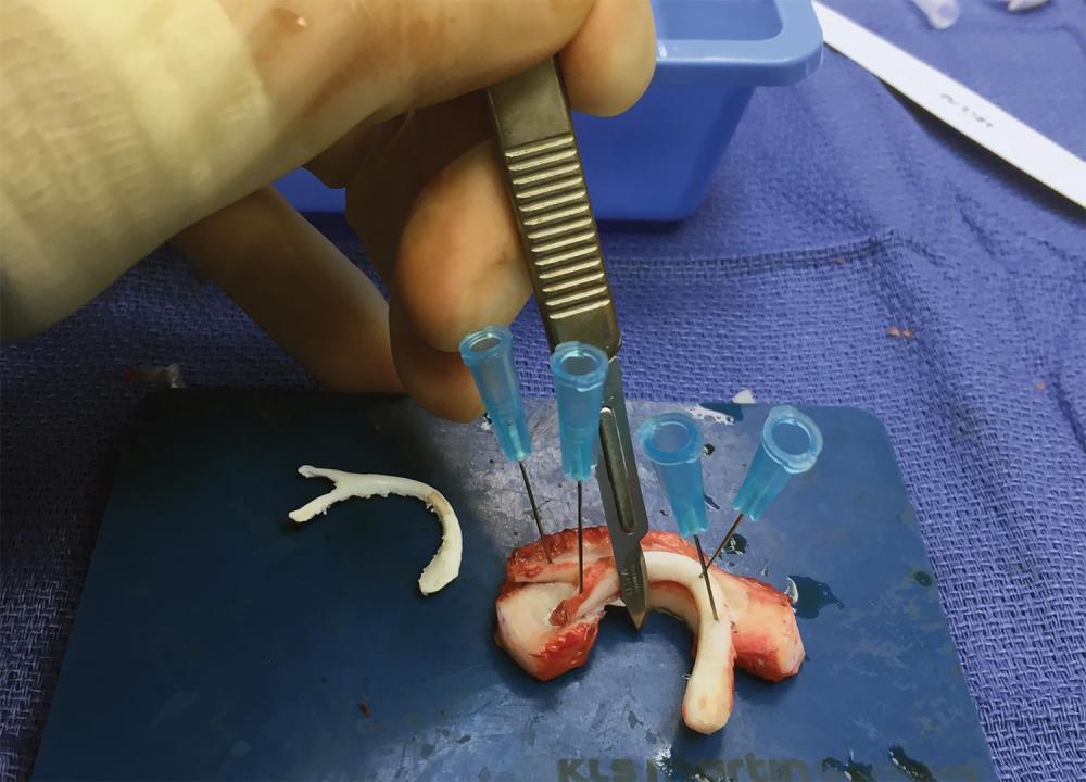 Cartilage for Ear Reconstruction