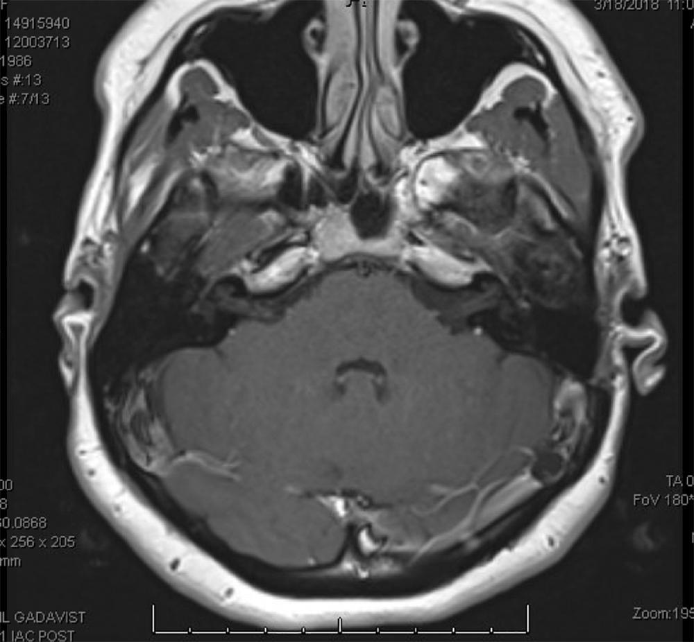 Postoperative MRI