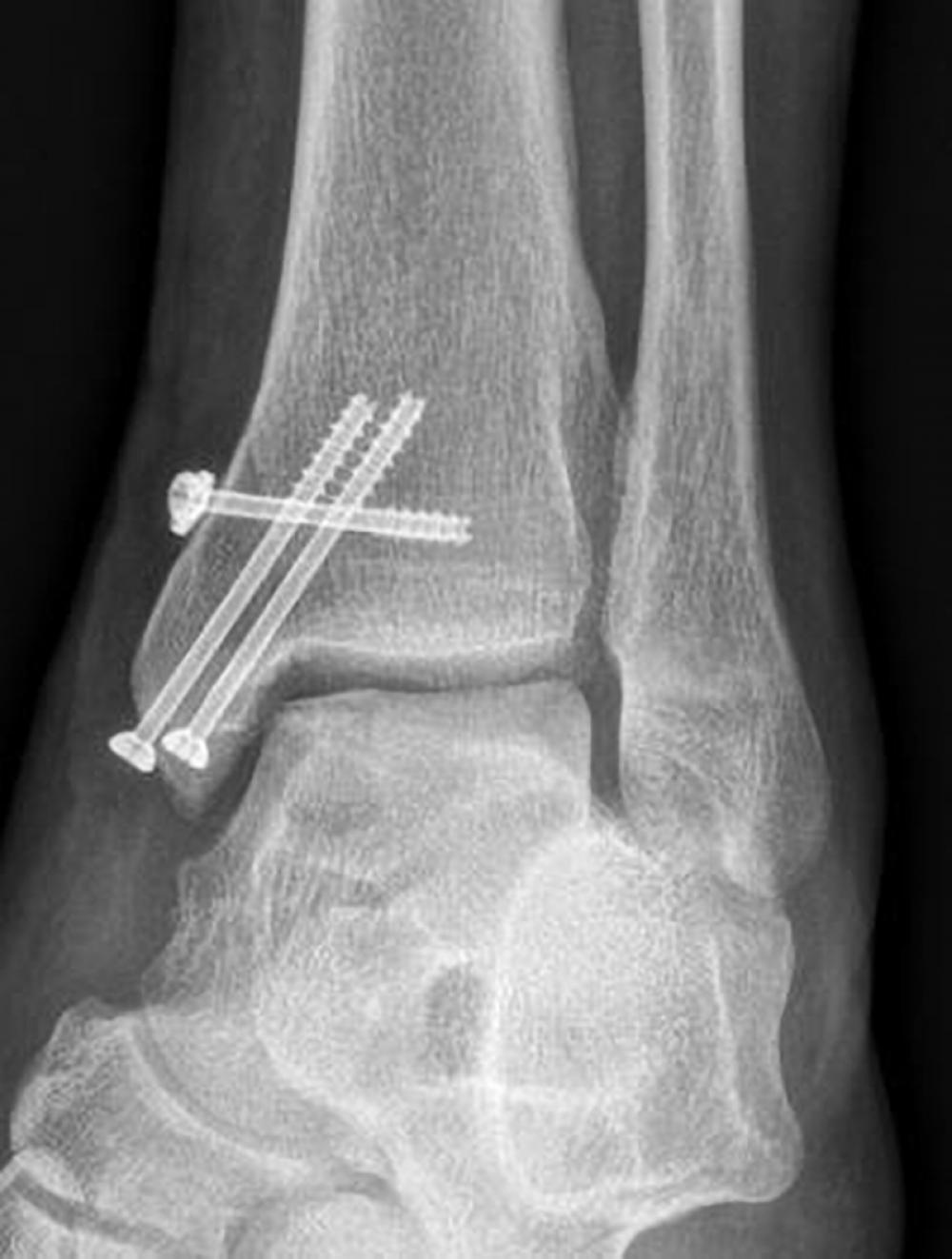 Post-operative X-ray of ankle