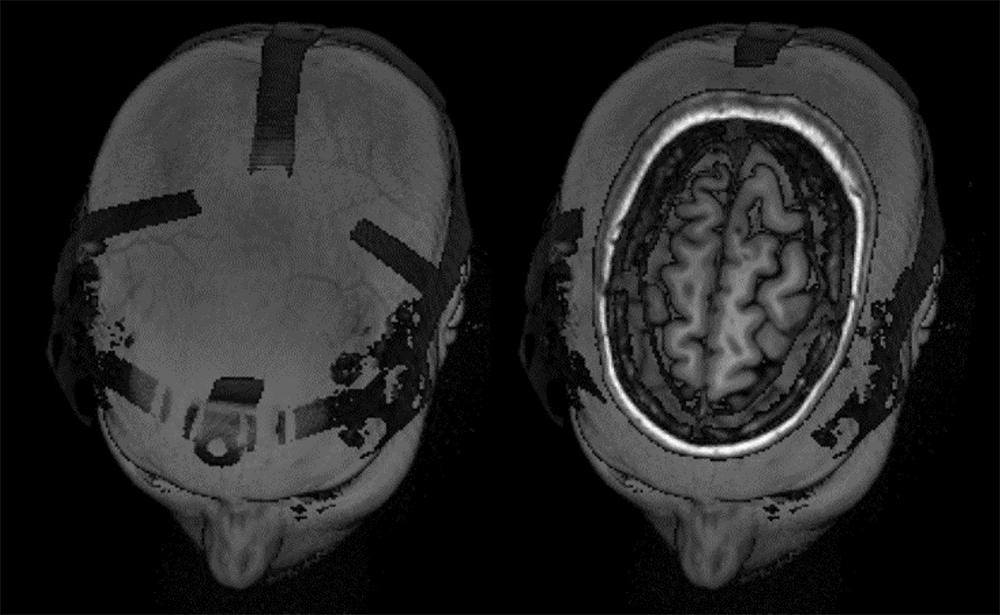 Brain MRI Results