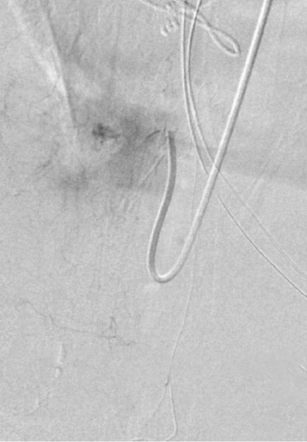 Angiogram After Arteriovenous Fistula Resection