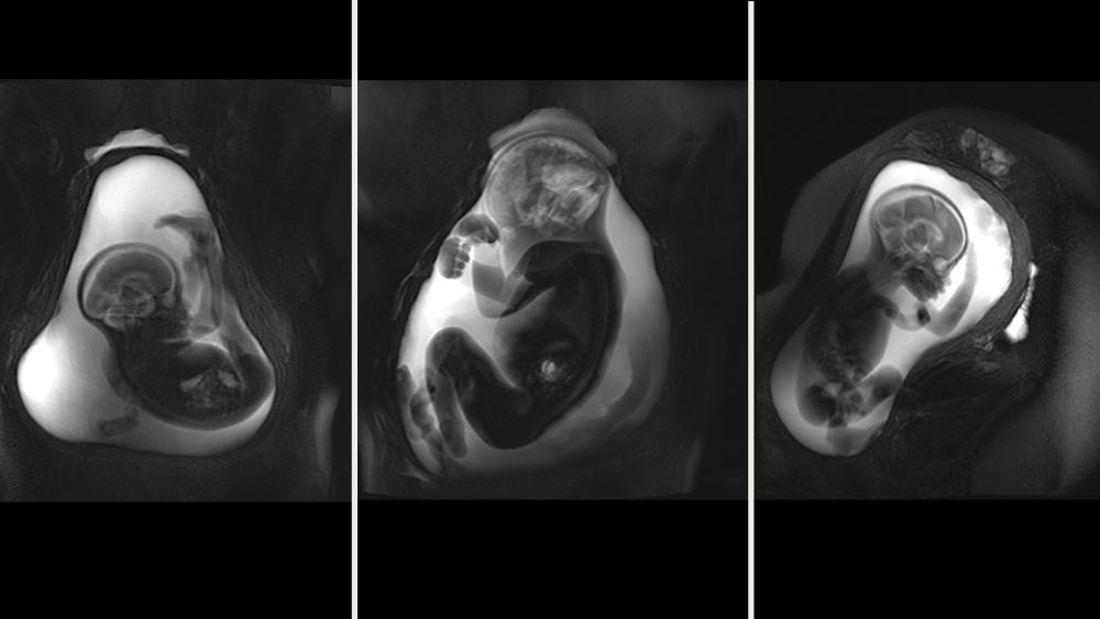 Fetal MRI Scans
