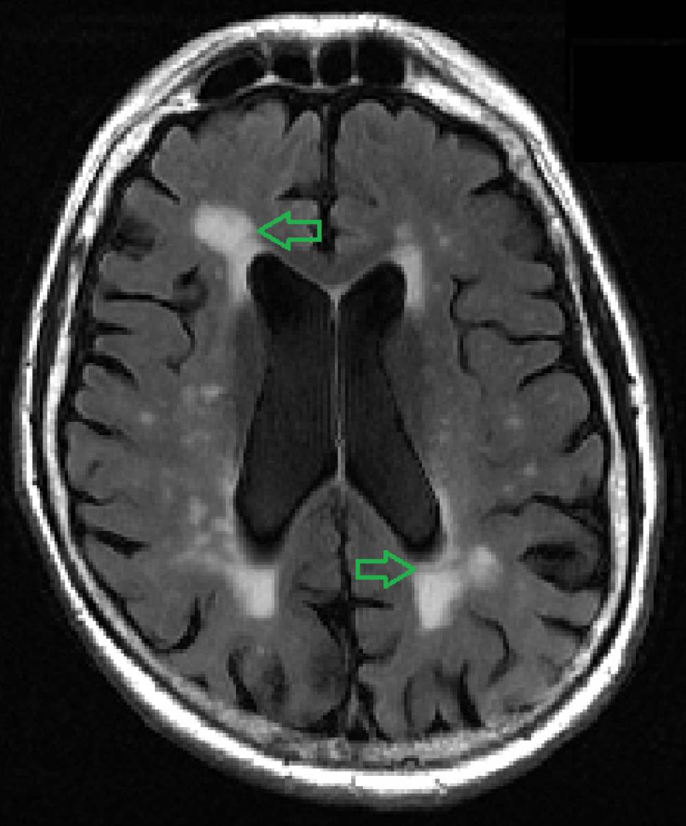 White Matter Lesion Mapping Tool Identifies Early Signs Of Dementia   Figure 1 Marked 