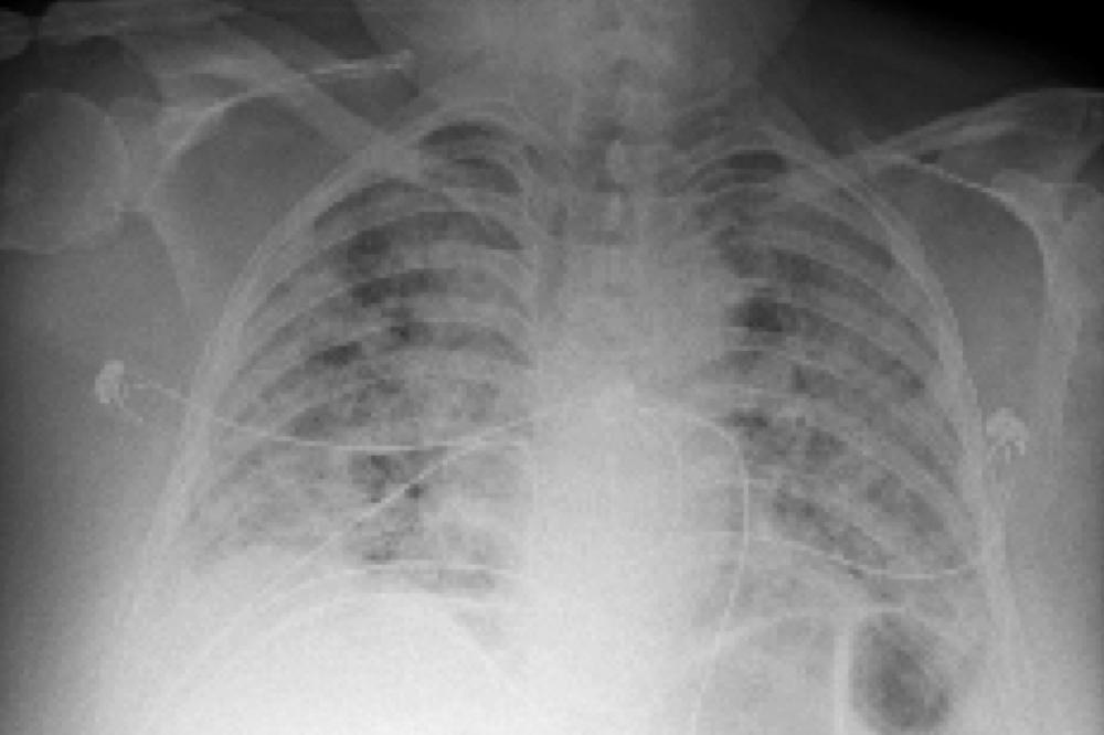 Chest-X Ray of Lung Tissue with COVID-19