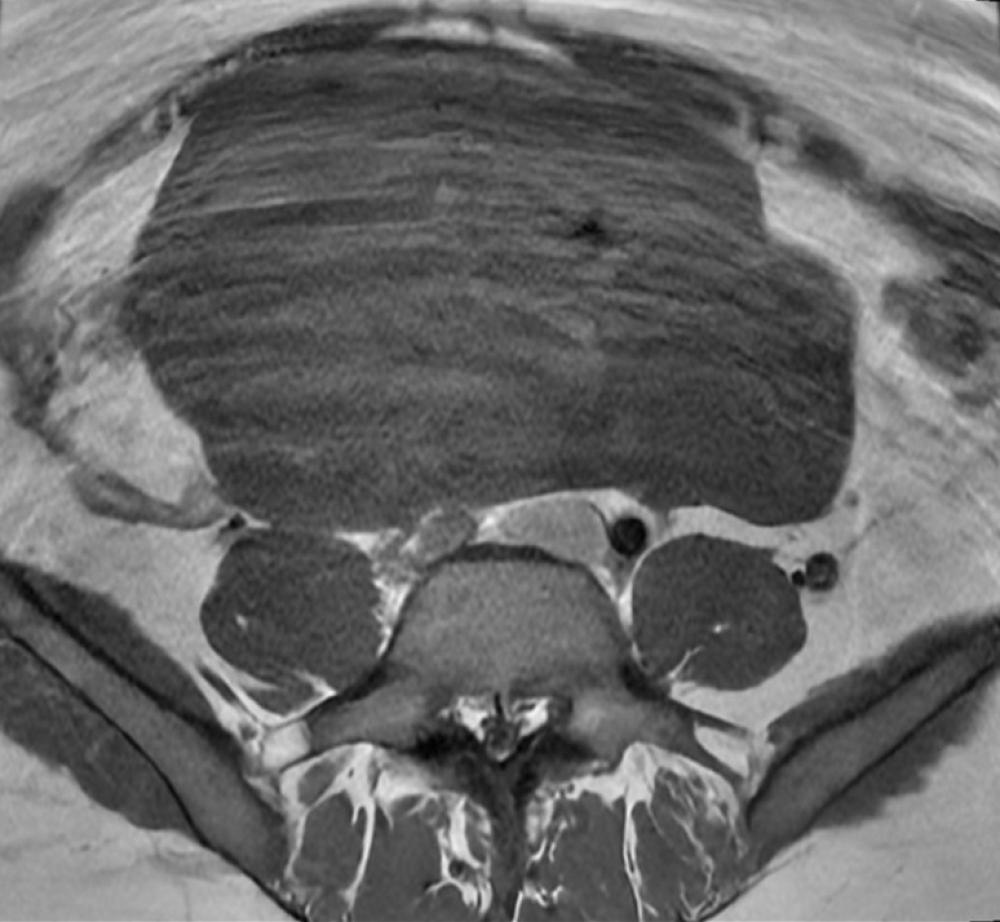 MRI Scan of Uterine Fibroid
