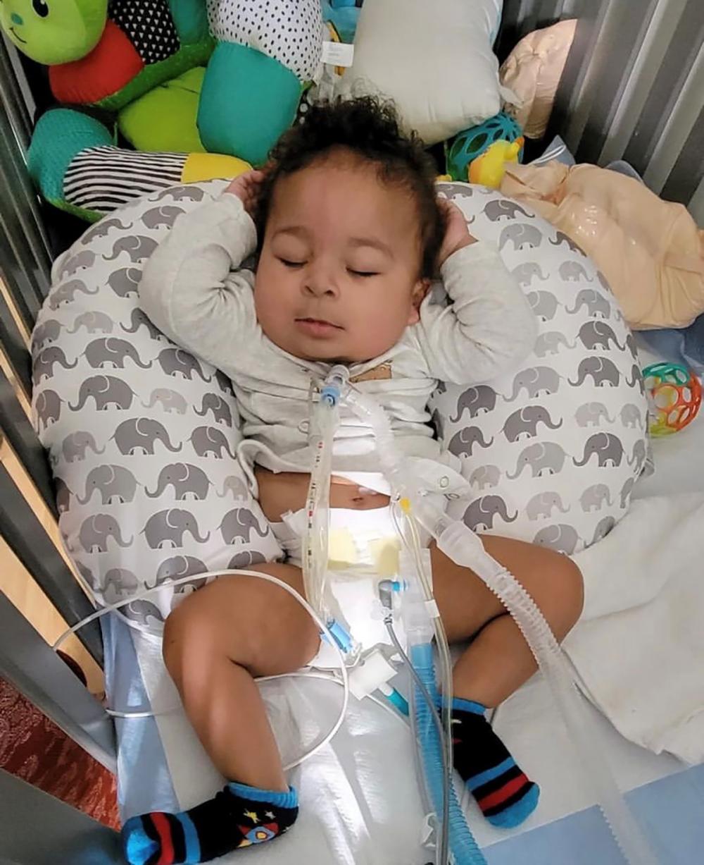 Aydin Martin, 11 Months Old, Sleeps with His Arms Clasped Behind His Head and Tracheal Tube Extending from His Throat