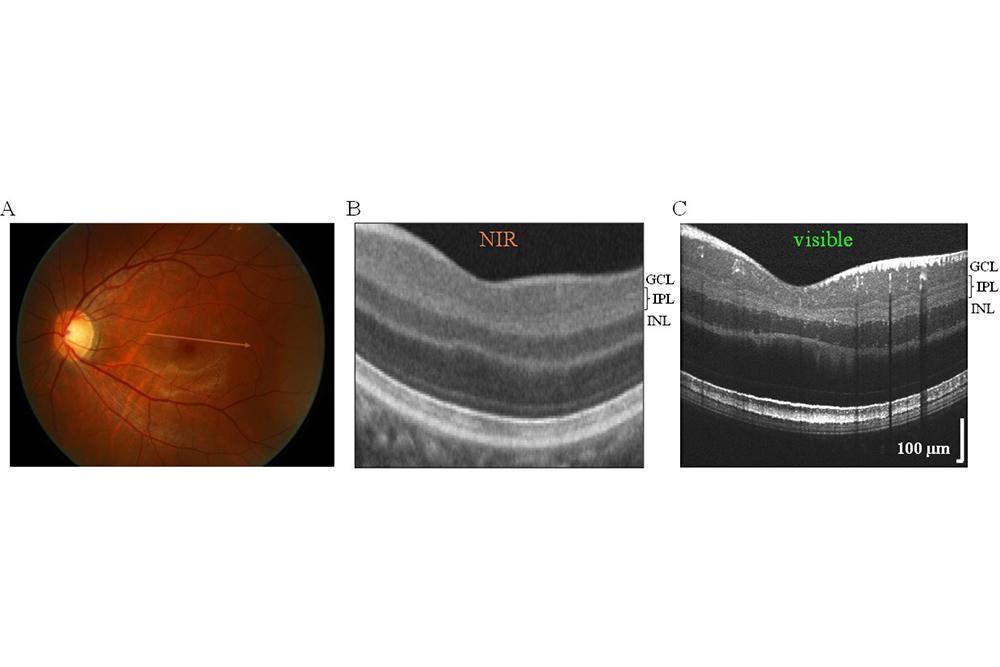 A photograph of the eye and an image using NIR and one using visible-light OCT of the same eye. The visible-light OCT image is more detailed. 