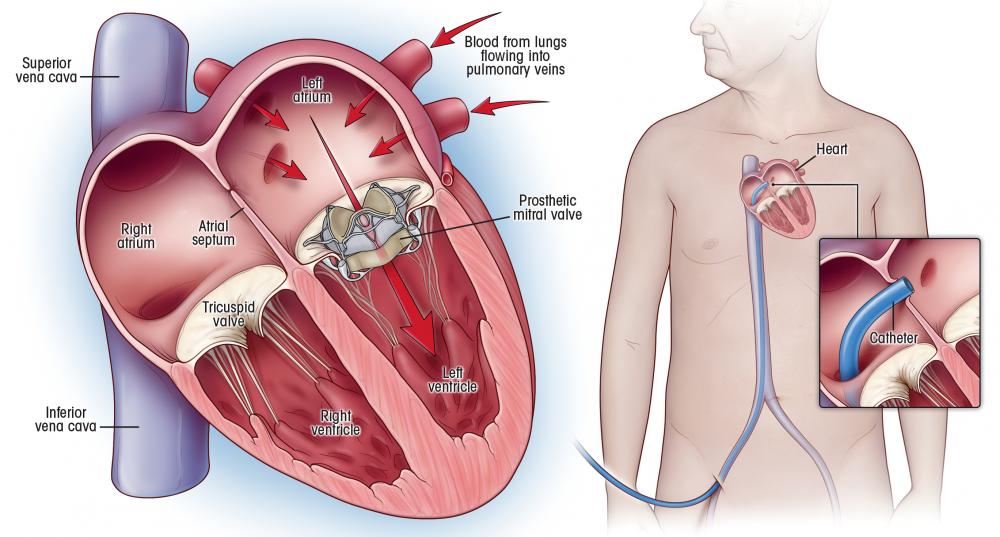 Mitral Valve Replacement Illustration