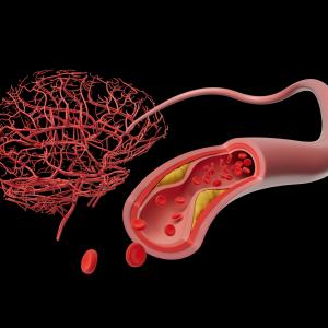 Conceptual illustration of a brain and an artery.  